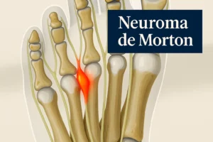 Neuroma de Morton