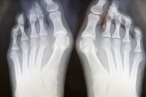 cirurgia de joanete